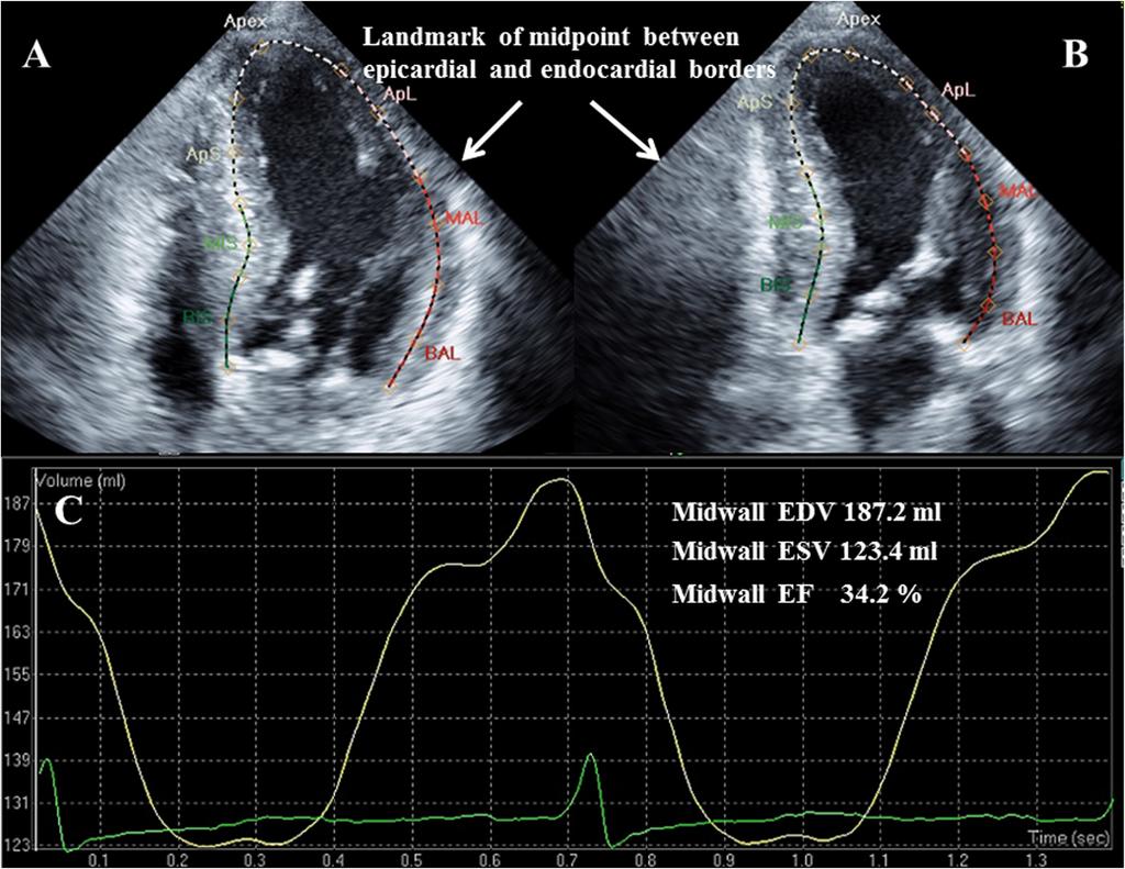 Yoshikawa et al. Cardiovascular Ultrasound 2012, 10:45 algorithm throughout the cardiac cycle and measured the end diastolic and end systolic volumes.