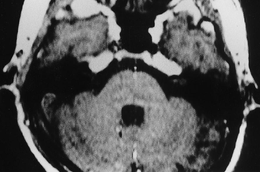 634 a b c d Fig. 1 Dynamic MRI of left trigeminal schwannoma (arrow) a before ab30 s c 60 s d 180 s e 210 s after administration of Gd- DTPA.