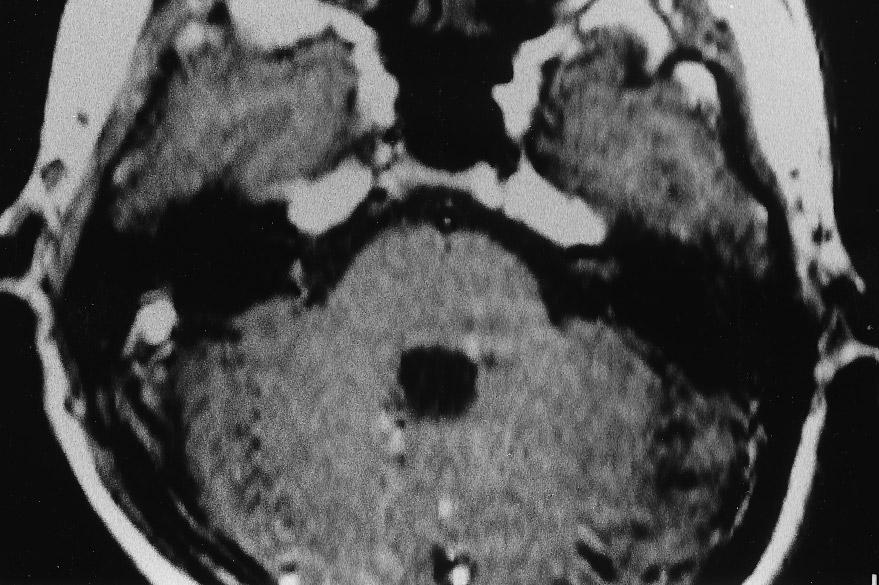 The sites of the meningiomas were: parasagittal in six, convexity in four, sphenoid ridge in three, parasellar in three, intraorbital in two, petrous ridge in two, tentorium in two and clivus in one.