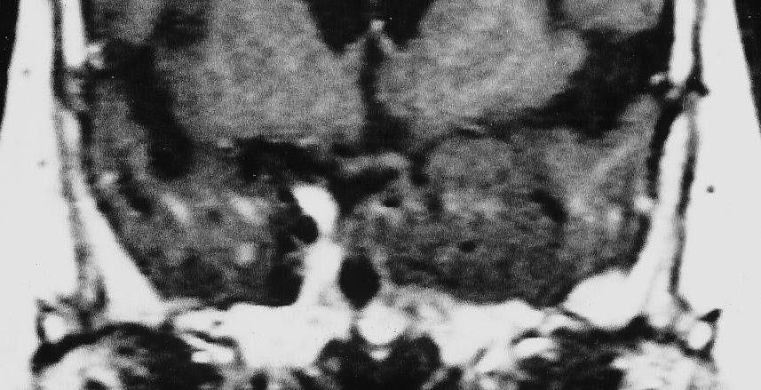 635 a b c d Fig. 2 Dynamic MRI of meningothelial meningioma of the left sphenoid ridge (arrow); timing as in Fig. 1.