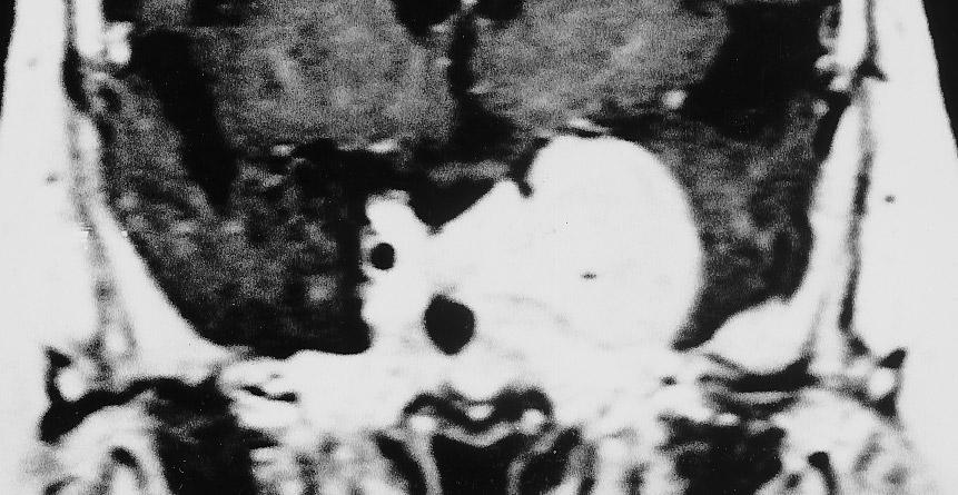 Meningiomas showed a variable dynamic pattern, with relatively homogeneous contrast enhancement. All meningothelial meningiomas showed rapid enhancement (Fig.
