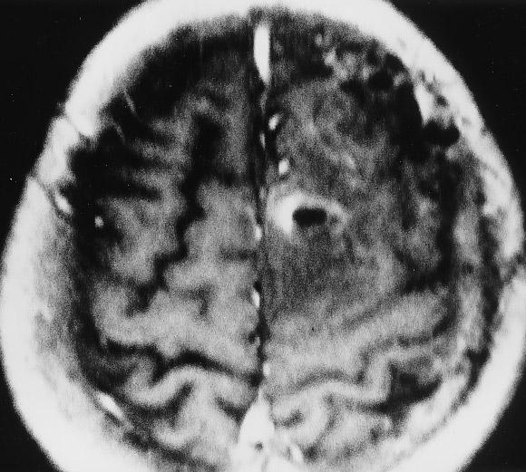 636 a b c Fig. 3 Dynamic MRI of left parasagittal fibrous meningioma (arrow); timing as in Fig. 1.