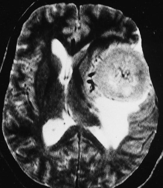 638 Fig. 8 T2-weighted image of meningothelial meningioma: the left sphenoid ridge meningioma gives slightly higher signal than cerebral cortex Fig.