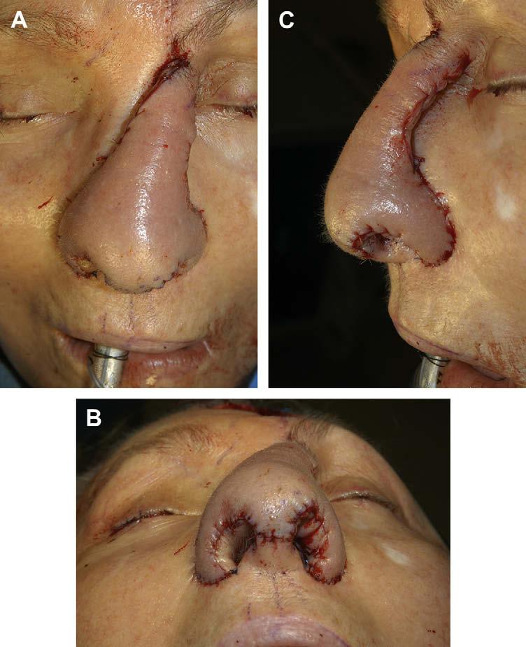 (A C) Containing an axial, musculocutaneous, and random blood supply, a forehead flap is