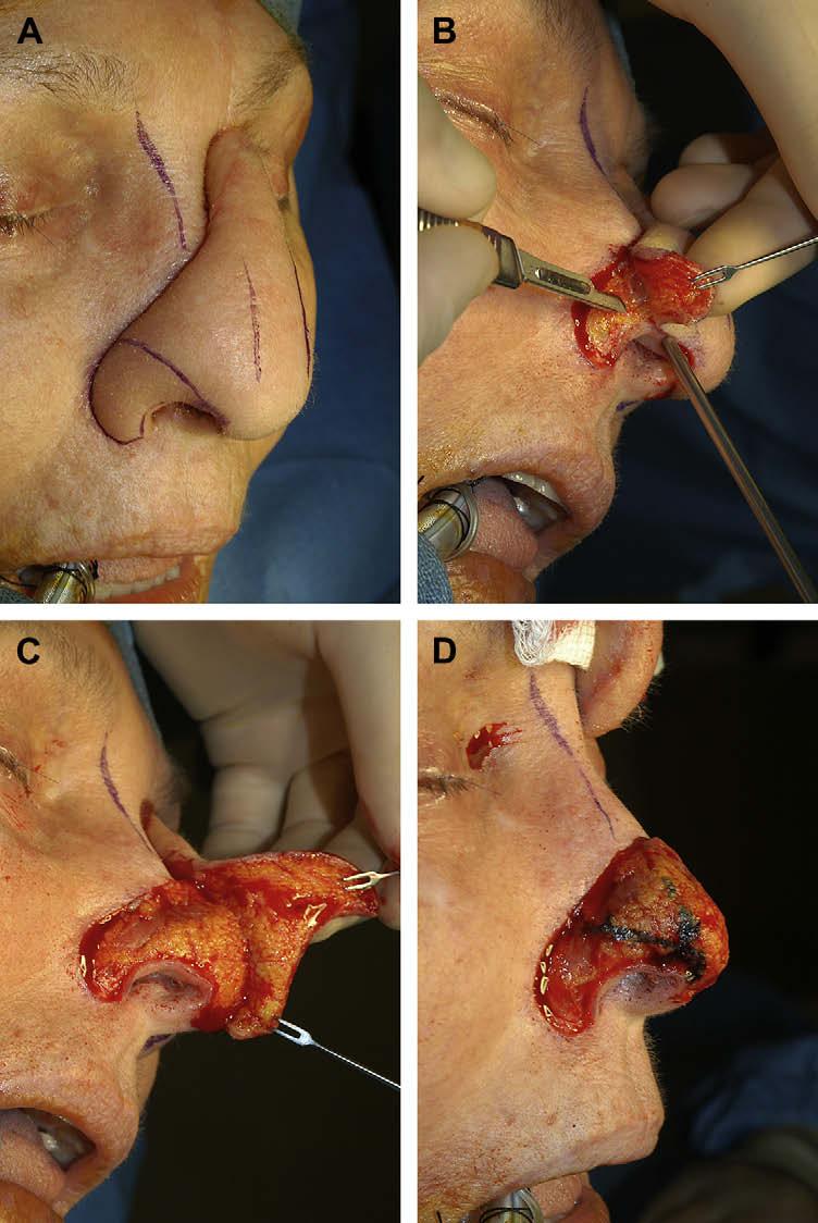 Author's personal copy Nasal Reconstruction with a Forehead Flap 453 Debris, granulation tissue, and irregular margins of the defect are trimmed.