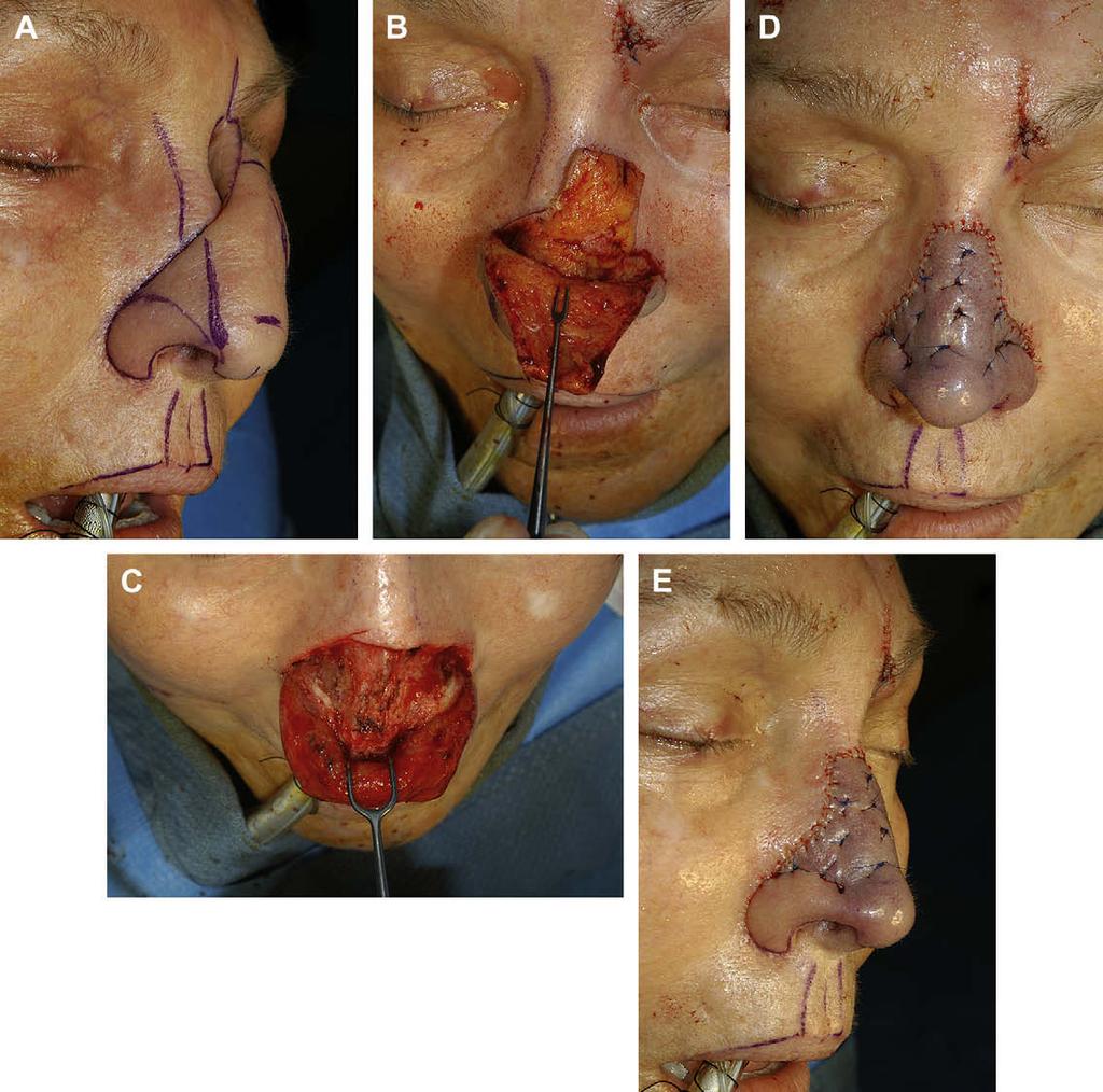 Author's personal copy Nasal Reconstruction with a Forehead Flap 457 Fig. 20. (A E) The pedicle is divided and skin over the superior aspect of the defect is elevated.