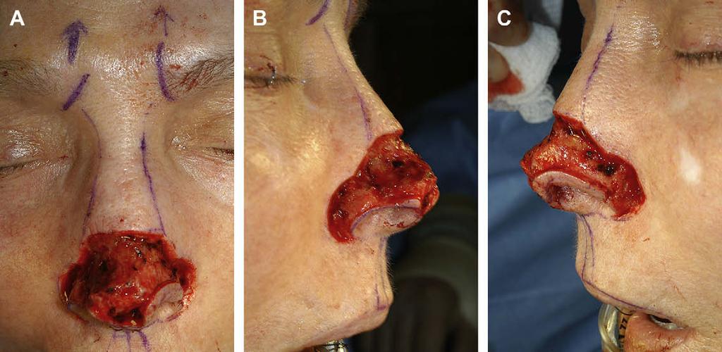 Author's personal copy Nasal Reconstruction with a Forehead Flap 449 can devascularize the flap and cause ischemia.