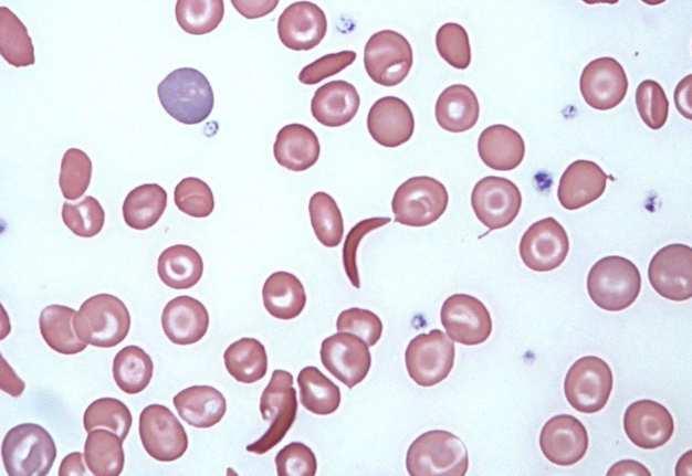 Sickle Cells Sickle-shaped, pointed at both ends Molecular aggregation of