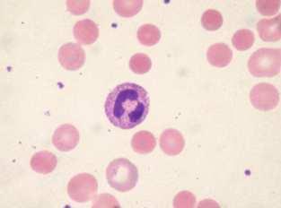 Case study #1: hematology results - cont. Manual differential/smear review was performed What do you see? Spherocytes Copyright 2018 Sysmex America, Inc. All rights reserved.