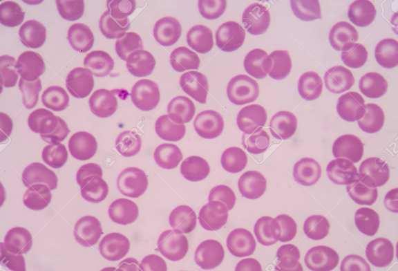 Hereditary stomatocytosis, Immune-hemolytic anemia Copyright 2018 Sysmex America, Inc.