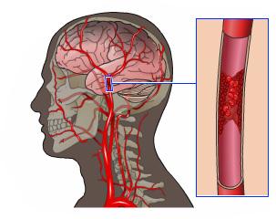 Strokes Introduction A stroke or a brain attack is a very serious condition that can result in death and significant disability.
