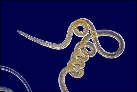 Five Most Common Parasites The filarial worm causes filariasis in humans