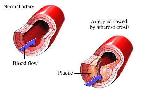 What is Atherosclerosis what is coronary artery disease? Over time, fatty deposits called plaque build up within the artery walls. The artery becomes narrow.