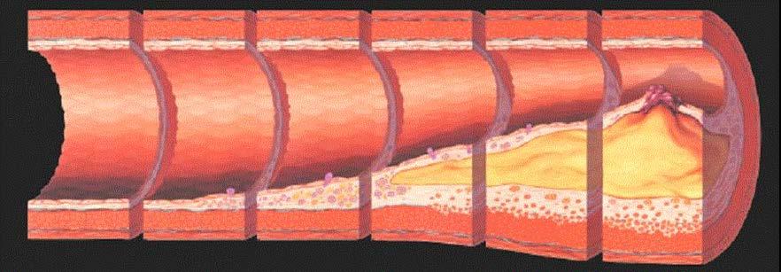 Foam Cells Myth : fat deposits at old age!