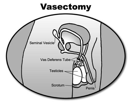 VASECTOMY INFORMATION AND CONSENT This information will help you understand more about the vasectomy: the indications for this procedure, the success and failure rates, the alternative forms of