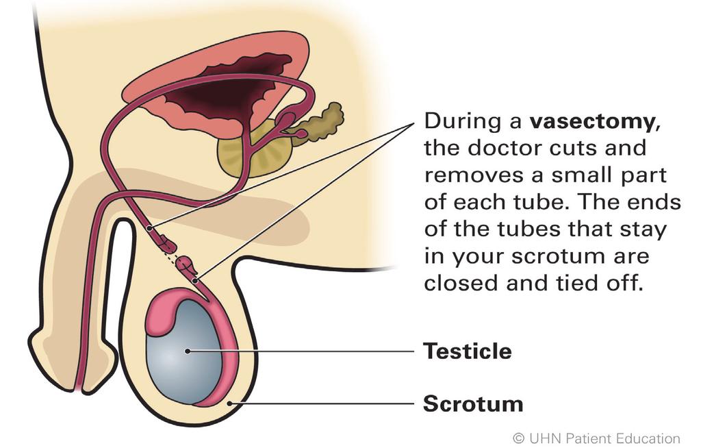 What is a vasectomy? A vasectomy is a surgical procedure that makes you sterile. This means you can t make a woman pregnant.