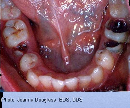 Dental Caries Disease Process Risk Factors High bacterial counts Family history