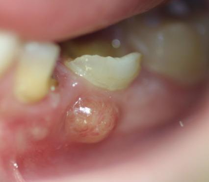 Dental Abscess By Damdent - Own work, CC BY-SA 3.0, https://commons.wikimedia.org/w/index.php?