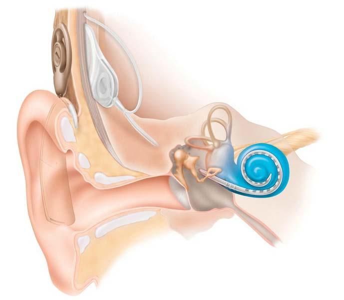 Enhancing speech recognition for cochlear implant users Dr.