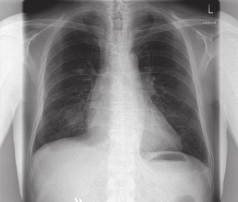 Chest radiographs on postoperative days 1, 5, and 11 revealed no infectious pathologic findings (Figures 1 A-C).