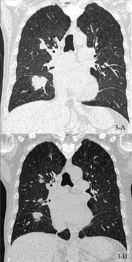 Andres Beiras-Fernandez et al /Experimental and Clinical Transplantation (2011) 4: 279-283 281 Figure 4. (A) A chest radiograph after 1 month follow-up revealed regression of the infiltrates.