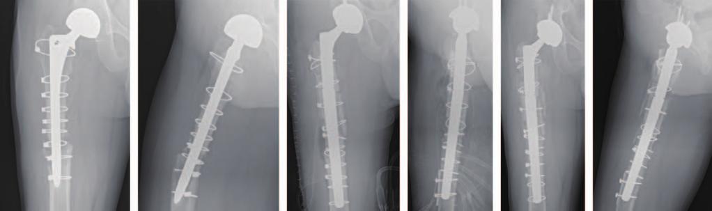 Joong-Myung Lee et al. Treatment of Periprosthetic Fracture Following Hip Arthroplasty stem loosening at two-year follow-up in this patient (Fig. 2).