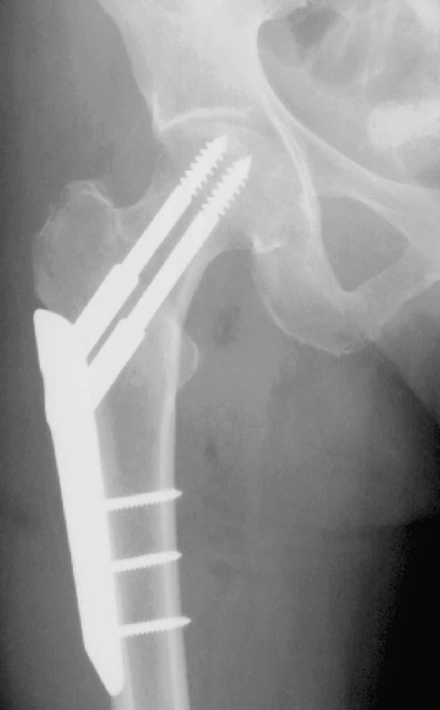 PCCP versus CHP for intertrochanteric hip fractures 1345 neck screw was positioned and drilled in the inferior neck border, adjacent to the calcar femorale.