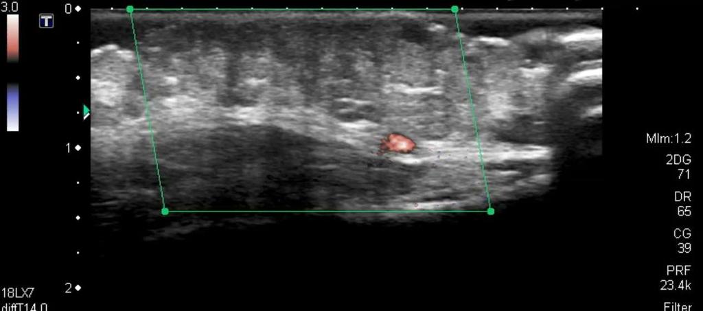 Venous malformation 13y : Mass left