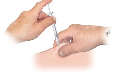 Prepare the injection site by cleaning with the alcohol swab.