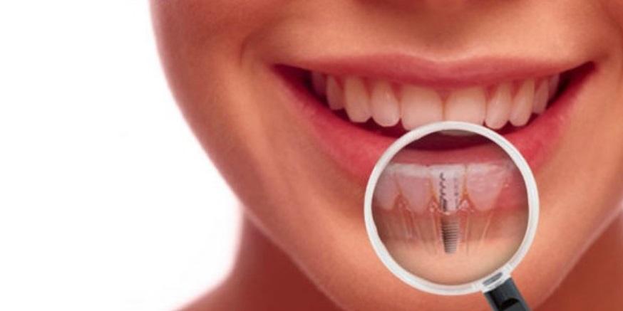 Introduction to Dental Implants At Adler Advanced Dentistry, we believe everyone deserves to have a healthy, beautiful smile.
