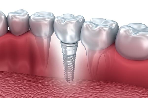 What Are Dental Implants? Originally invented in Sweden, dental implants are artificial roots made of ultra-strong titanium resembling a large screw which are implanted into the jawbone.