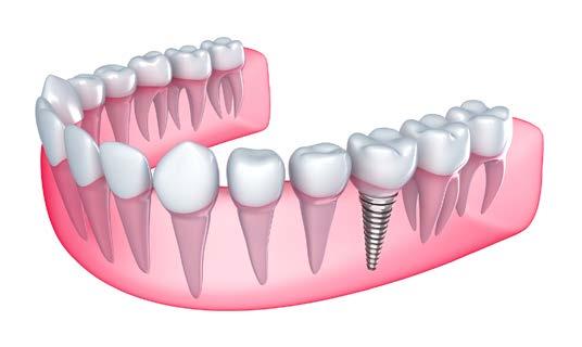 Dental Implant Benefits There are many reasons why having all of your teeth is important for a healthy functioning mouth.