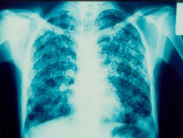 When disseminated forms of TB are suspected, treatment should be