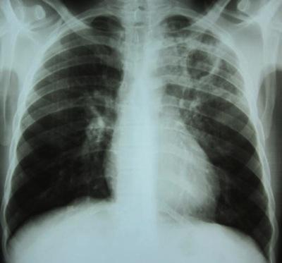 Lesions due to tuberculosis can be unilateral or bilateral. They are most frequently observed in the upper zones of the radiograph.