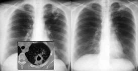 Chronic forms of TB When the tuberculosis has progressed over several months, the destruction of the lung parenchyma and gradual fibrosis lead to retraction of the