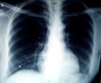 Pulmonary TB in children can range from an asymptomatic primary infection to a progressive primary TB.