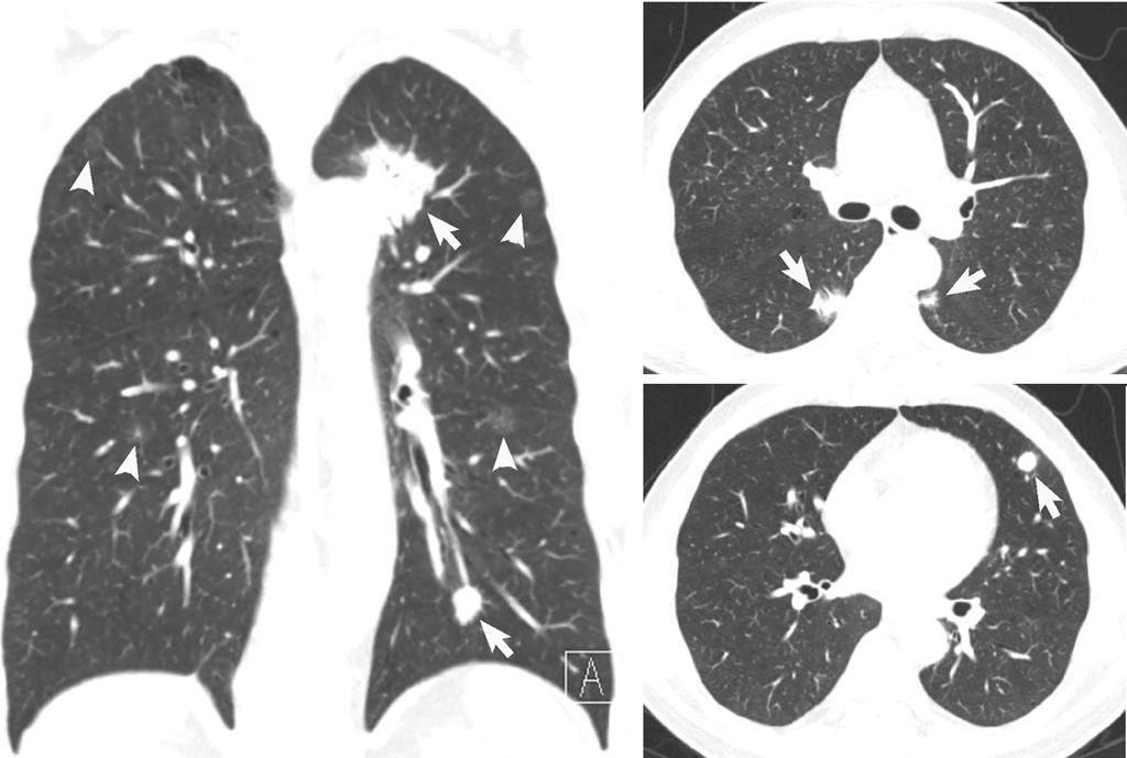 5340 Li et al. Early diagnosis and prognosis of stage I A B C Figure 2 Chest CT indicates multiple lung nodules/masses ( 9) located in the lungs bilaterally. (A) Coronal CT showing a solid mass (4.