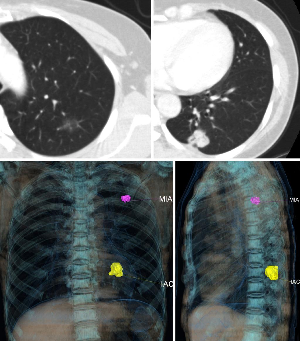 Journal of Thoracic Disease, Vol 9, No 12 December 2017 5341 A B C D Figure 3 A 52-year-old woman with double primary lung cancer. (A) There was a part solid GGN in the left upper lung (1.6 cm 1.