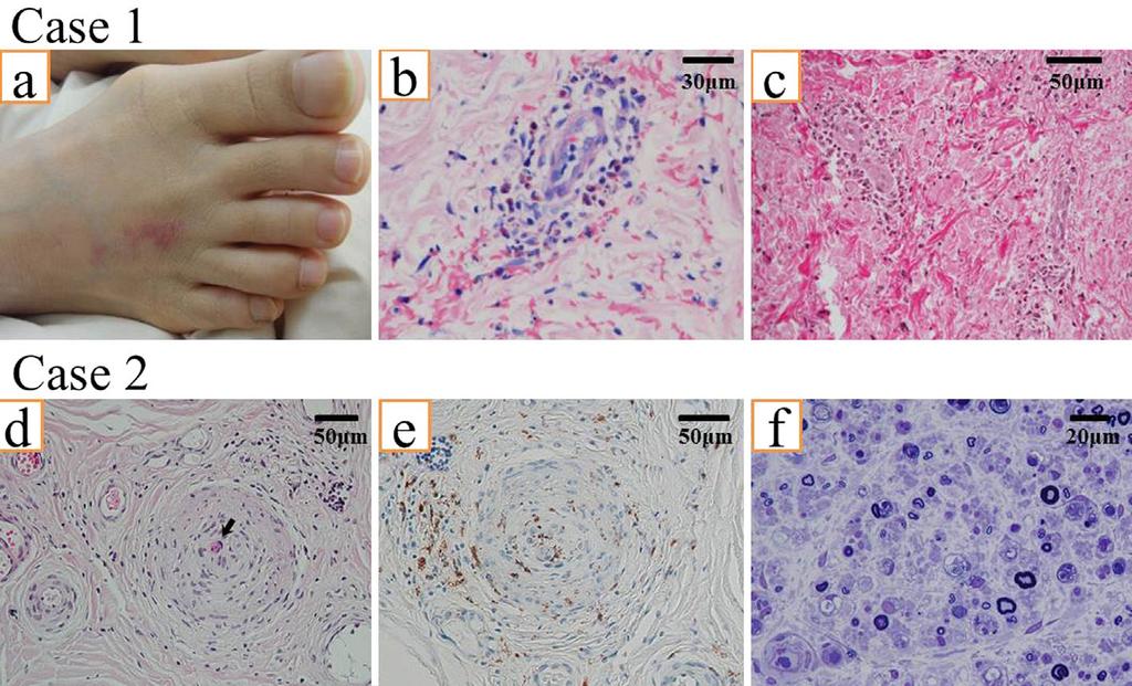 Figure 1. (a) Purpura on the left lower leg in case 1. (b) The result of purpura biopsy with Giemsa stain shows eosinophilic infiltration in extravascular areas.