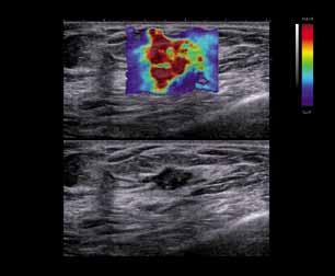 tissue elasticity. Previous generations of strain/stress elastography requires the operator to manipulate the transducer, making the results subjective and operator dependent.