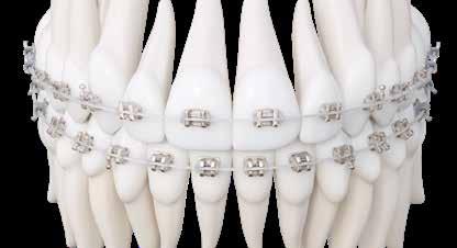 ICONIX PAIRING OPTIONS TECHNIQUES Central Lateral Cuspid 1st Bicuspid 2nd Bicuspid 1st Molar 2nd Molar MAXILLARY Torq. Ang. Torq. Ang. Torq. Ang. Rot.