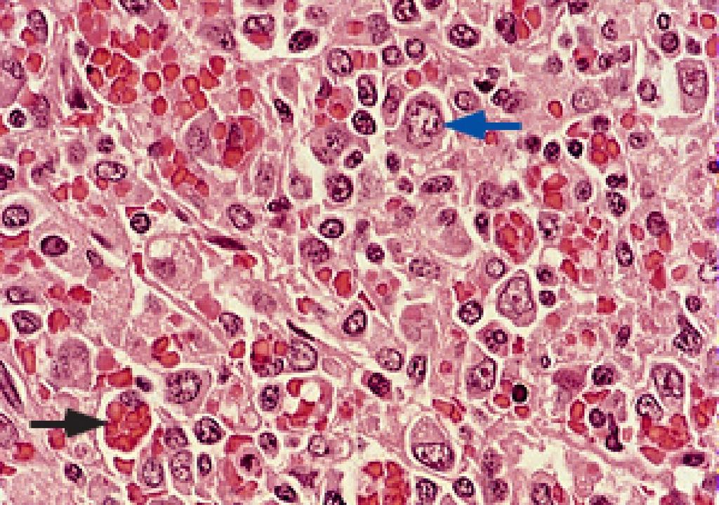 Large T cell lymphoma with reactive hemophagocytosis The red pulp of