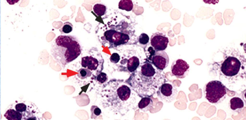 Infection-associated hemophagocytic syndrome Bone marrow from a