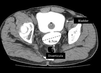 elevated incidence of BD due to an increase of bladder damage secondary to longer periods of obstruction.