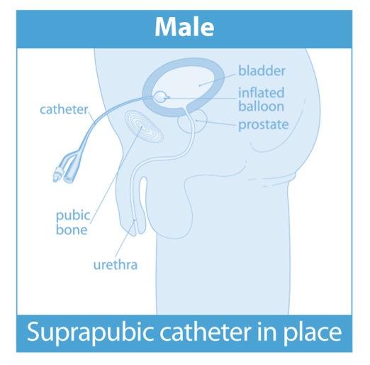 What is a urinary catheter? A urinary catheter is a flexible, soft, hollow tube that is placed into the bladder to drain urine.