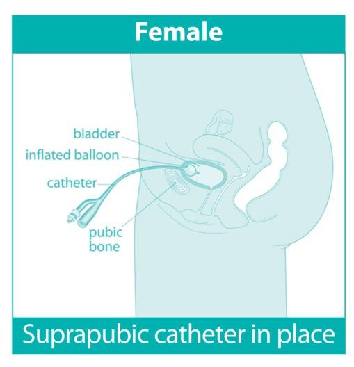 catheter). The catheter allows urine to drain from the bladder into a drainage bag. A small balloon keeps the catheter in place inside the bladder. Why is a urinary catheter needed?