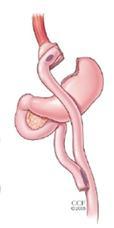 Early (< 30 days) Most common complications after Gastric bypass Late Leak with peritonitis (0.1-5.6%) Stomal stenosis/stricture (1-5%) PE/DVT (< 1.