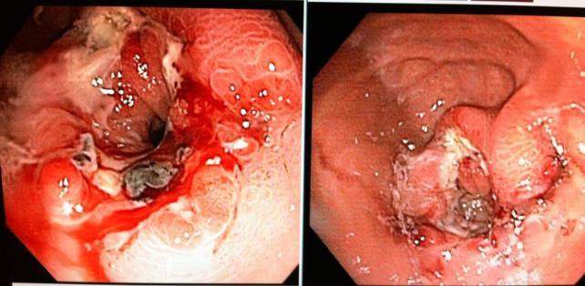 Marginal Ulcer (Bleeding) Up to 16% reported Risk associated with Hyperacidity (Pouch size) Persistent H.