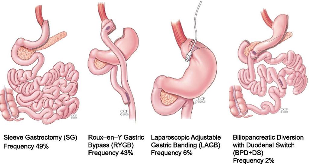 Bariatric Surgery Now Data ASMBS 2015 (n= 196000) 2016: