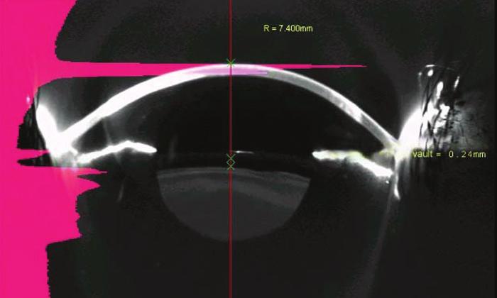 Evolution of Indications for the Visian ICL Implantation of this lens is not just for patients with high myopia anymore.
